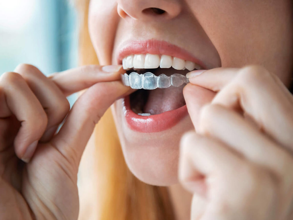 female putting invisalign on her teeth