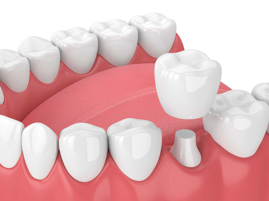 dental crown and bridge graphic