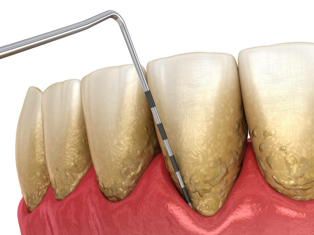 periodontal disease graphic