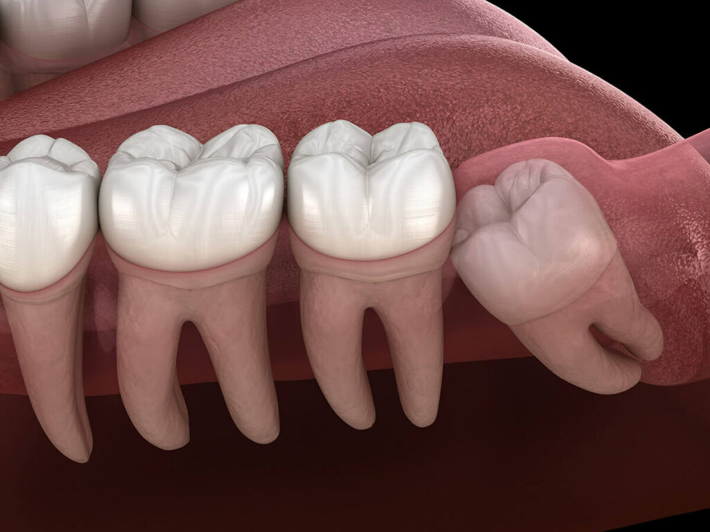 impacted wisdom tooth graphic