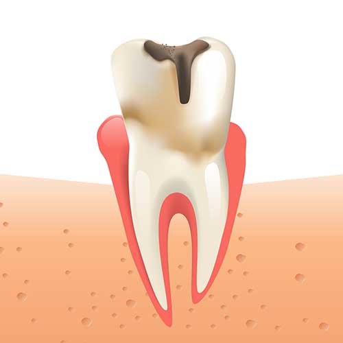 cavity on tooth graphic