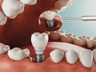 3D illustration of a dental implant inside the mouth, showing screw placement in the gum and crown attachment.