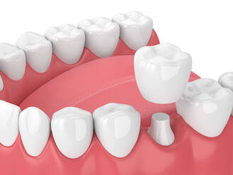 3D rendering of dental crown placement showing prepared molar and crown positioned above for fitting.